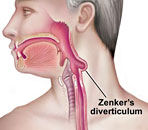 Zenkers